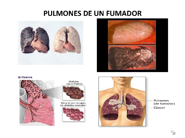 PULMONES DE UN FUMADOR 21 21 PULMONES DE UN FUMADOR 21 21