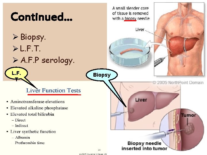 Continued… Biopsy. L. F. T. A. F. P serology. L. F. T Biopsy 
