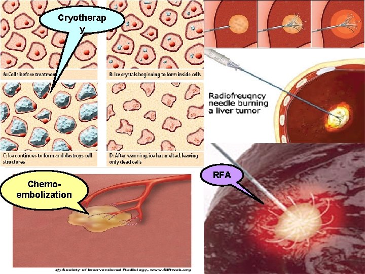 Cryotherap y Chemoembolization RFA 