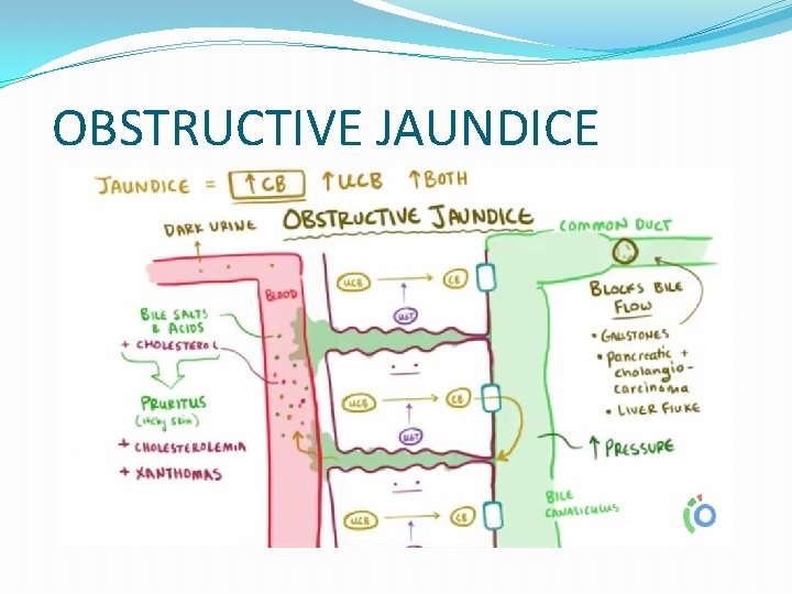 OBSTRUCTIVE JAUNDICE OBSTRUCTIVE JAUNDICE