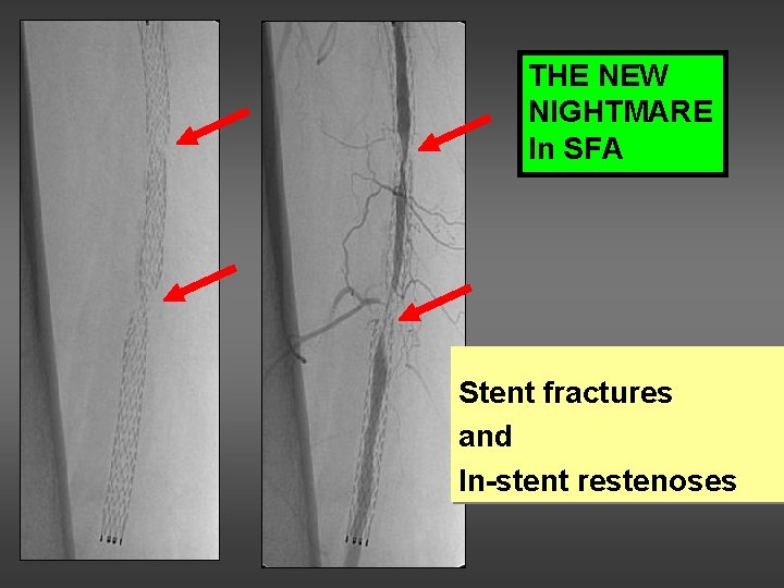 THE NEW NIGHTMARE In SFA Stent fractures and In-stent restenoses 