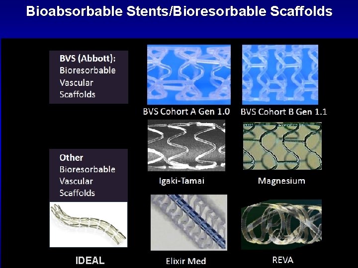 Bioabsorbable Stents/Bioresorbable Scaffolds IDEAL 
