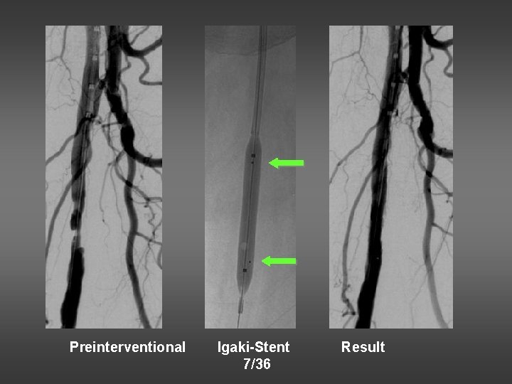 Preinterventional Igaki-Stent 7/36 Result 