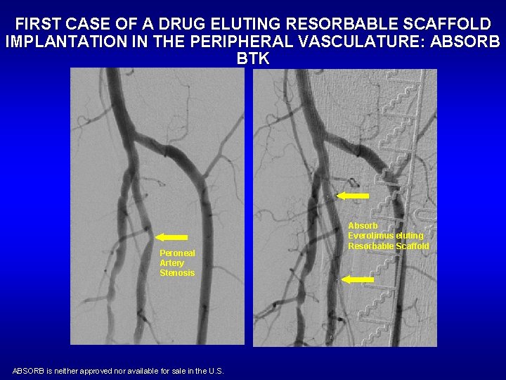 FIRST CASE OF A DRUG ELUTING RESORBABLE SCAFFOLD IMPLANTATION IN THE PERIPHERAL VASCULATURE: ABSORB