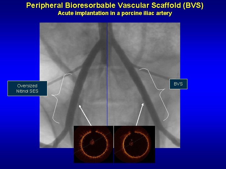 Peripheral Bioresorbable Vascular Scaffold (BVS) Acute implantation in a porcine iliac artery Oversized Nitinol