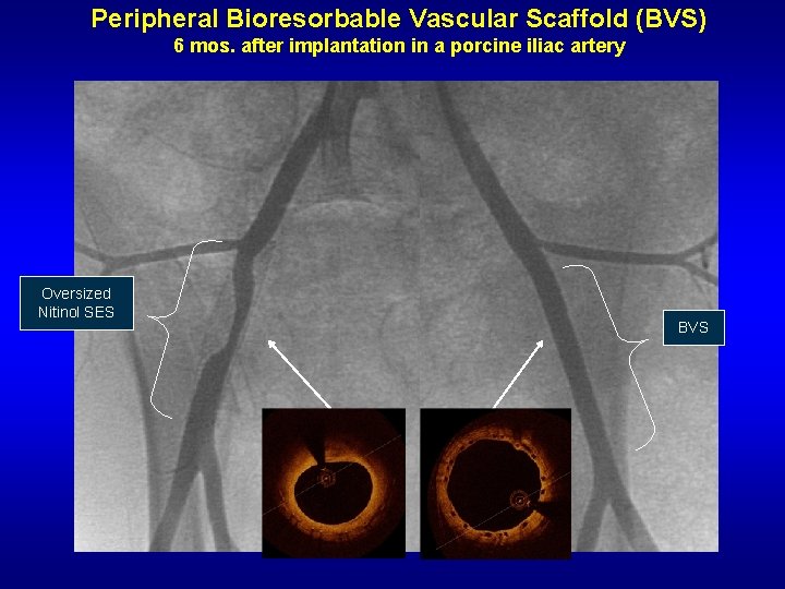 Peripheral Bioresorbable Vascular Scaffold (BVS) 6 mos. after implantation in a porcine iliac artery