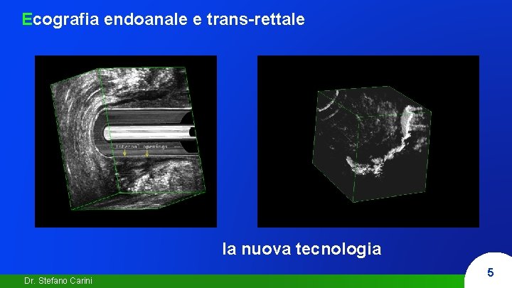 Ecografia endoanale e trans-rettale la nuova tecnologia Dr. Stefano Carini 5 