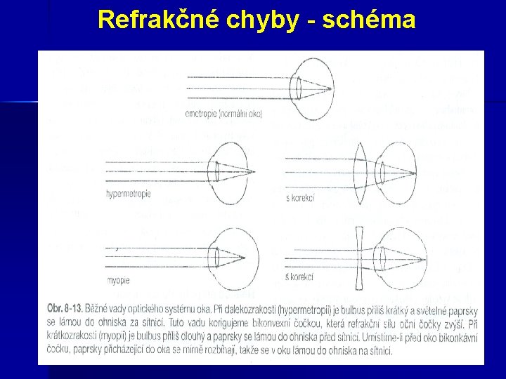  Refrakčné chyby - schéma 