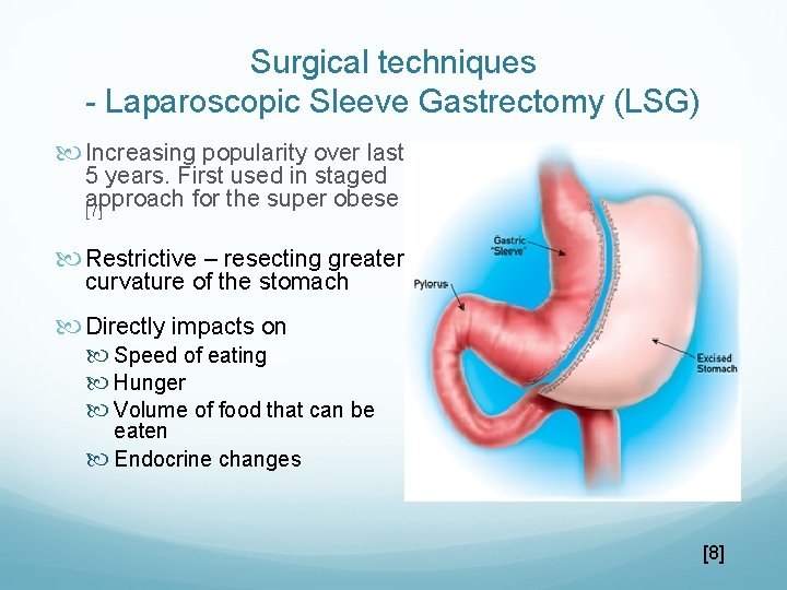 Surgical techniques - Laparoscopic Sleeve Gastrectomy (LSG) Increasing popularity over last 5 years. First