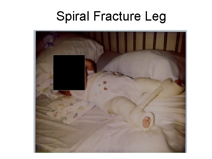 Spiral Fracture Leg 