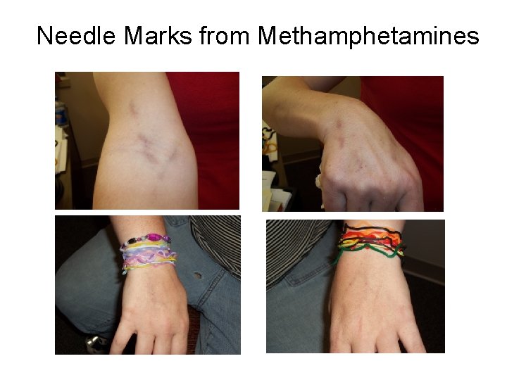 Needle Marks from Methamphetamines 