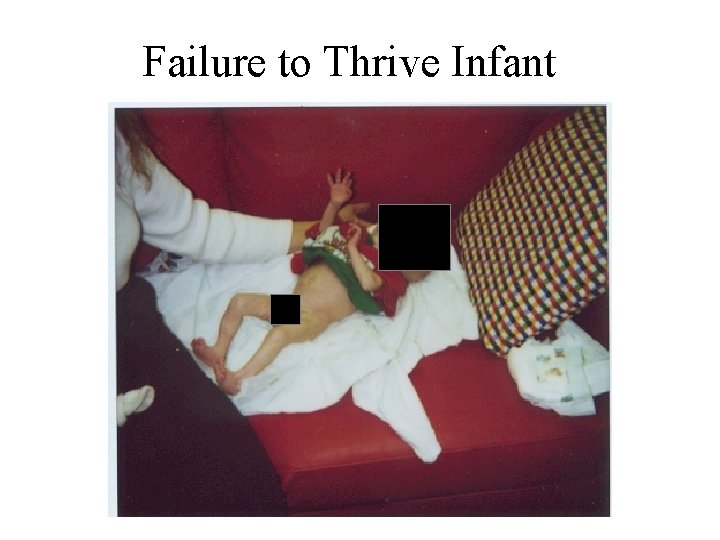 Failure to Thrive Infant 