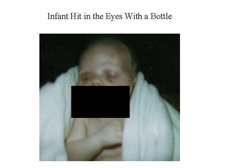 Infant Hit in the Eyes With a Bottle 