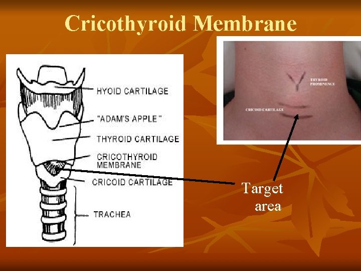 Cricothyroid Membrane Target area 