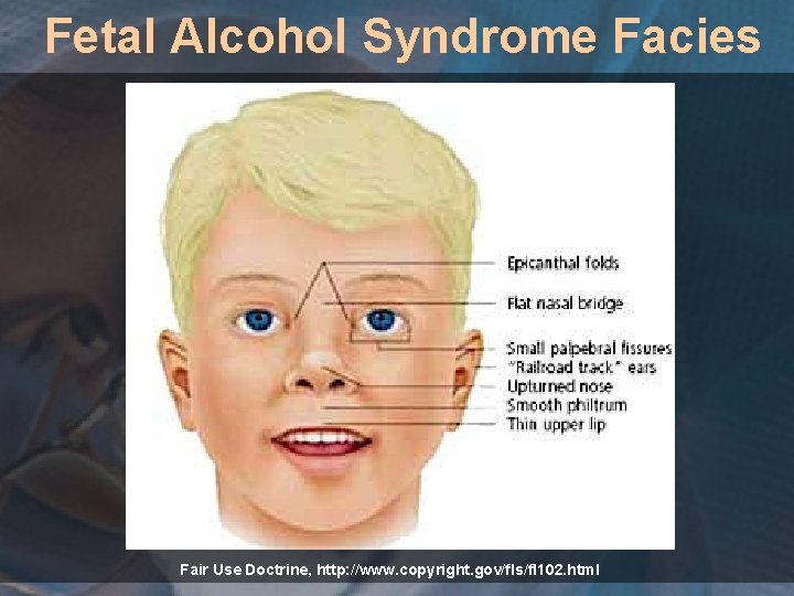 Fetal Alcohol Syndrome Facies Fair Use Doctrine, http: //www. copyright. gov/fls/fl 102. html 