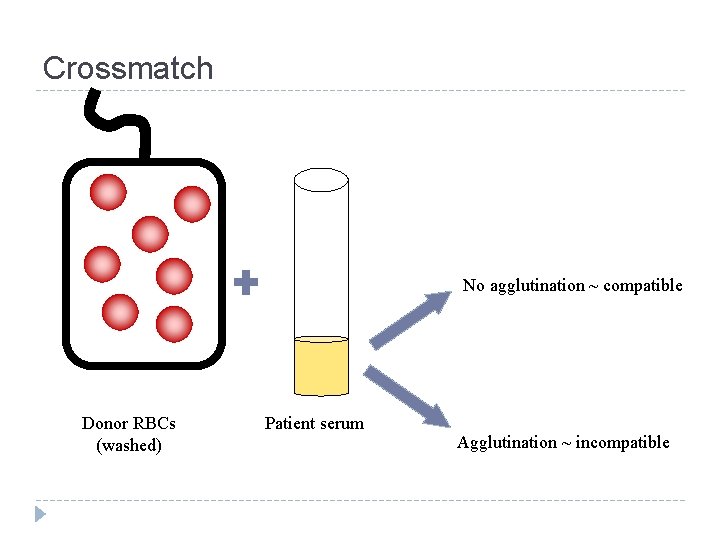 Crossmatch No agglutination ~ compatible Donor RBCs (washed) Patient serum Agglutination ~ incompatible 