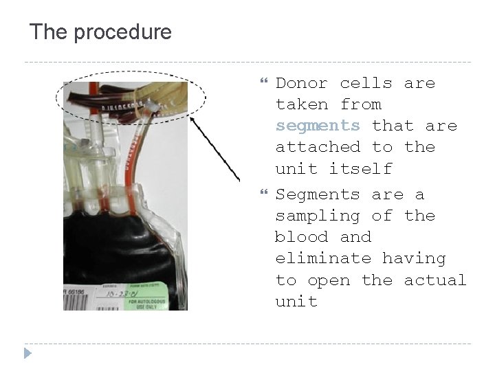 The procedure Donor cells are taken from segments that are attached to the unit