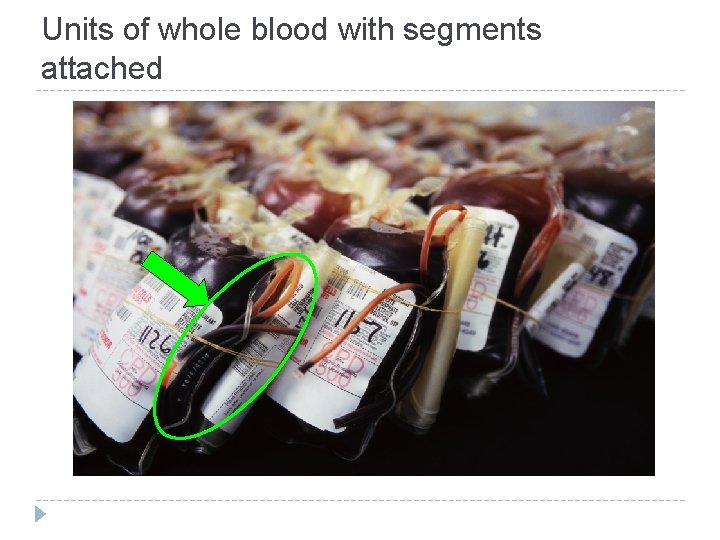 Units of whole blood with segments attached Units of whole blood with segments attached