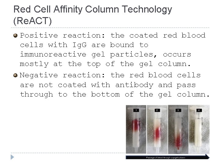 Red Cell Affinity Column Technology (Re. ACT) Positive reaction: the coated red blood cells