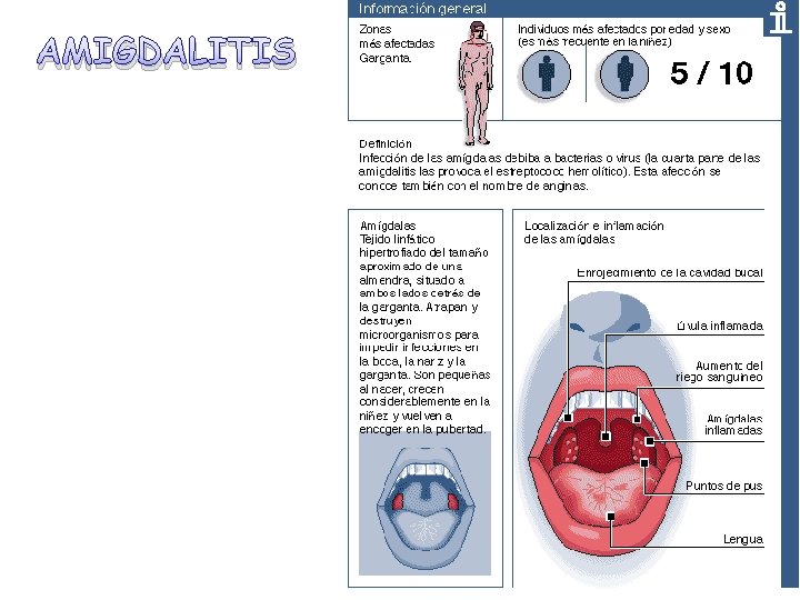 AMIGDALITIS 