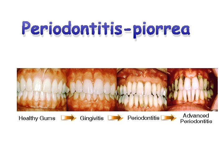 Periodontitis-piorrea 