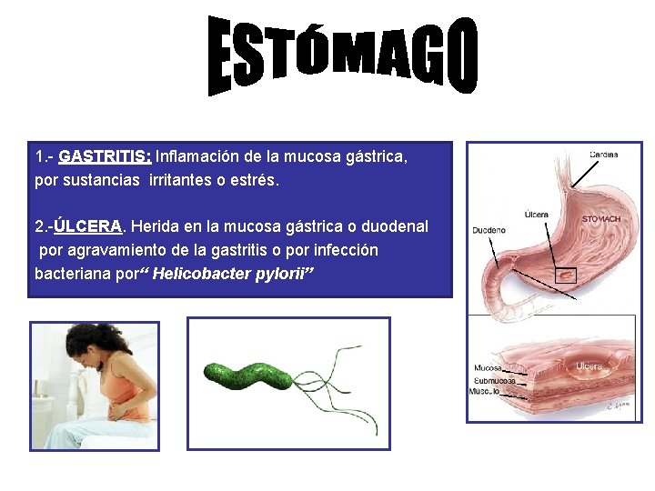 1. - GASTRITIS: Inflamación de la mucosa gástrica, por sustancias irritantes o estrés. 2.