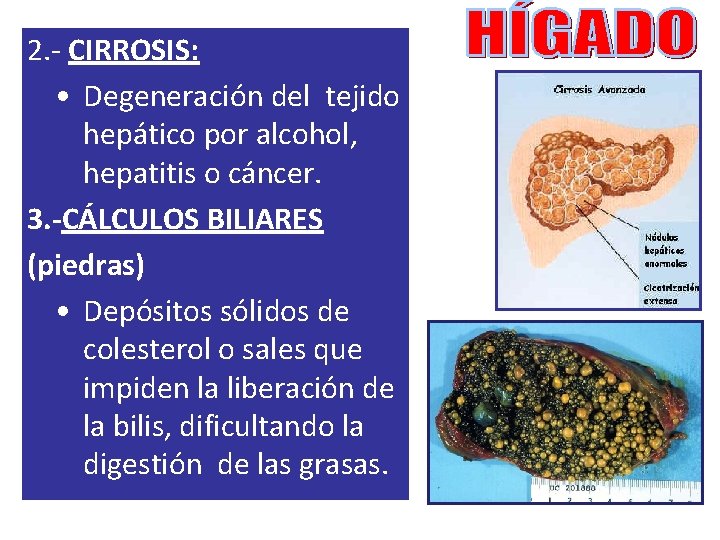 2. - CIRROSIS: • Degeneración del tejido hepático por alcohol, hepatitis o cáncer. 3.