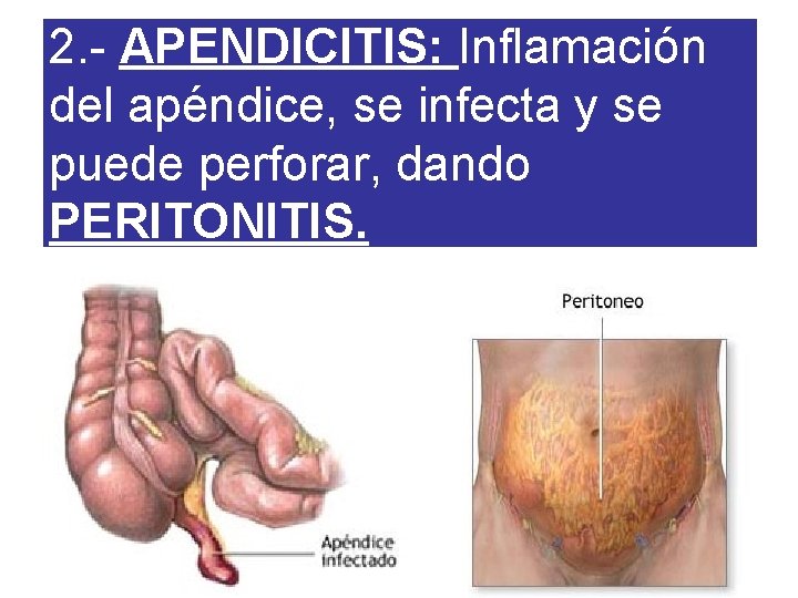 2. - APENDICITIS: Inflamación del apéndice, se infecta y se puede perforar, dando PERITONITIS.