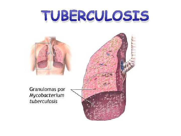 TUBERCULOSIS 