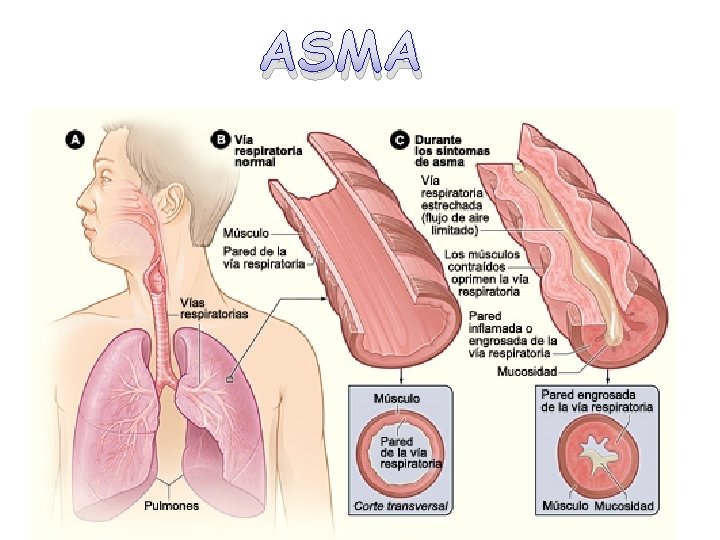 ASMA 