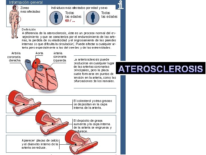 ATEROSCLEROSIS 