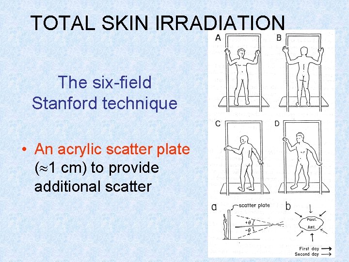 TOTAL SKIN IRRADIATION The six-field Stanford technique • An acrylic scatter plate ( 1