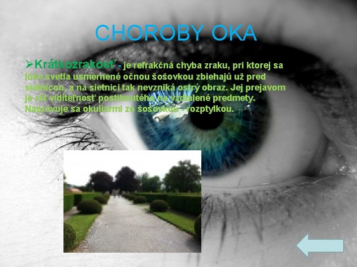 CHOROBY OKA ØKrátkozrakosť - je refrakčná chyba zraku, pri ktorej sa lúče svetla usmernené