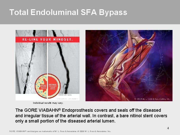 Total Endoluminal SFA Bypass Individual results may vary. The GORE VIABAHN® Endoprosthesis covers and