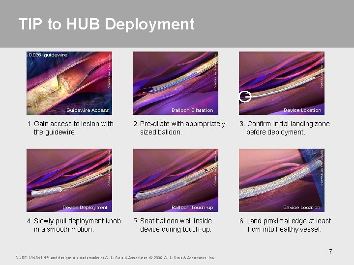 TIP to HUB Deployment 0. 035" guidewire Guidewire Access 1. Gain access to lesion