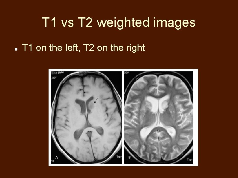 T 1 vs T 2 weighted images T 1 on the left, T 2