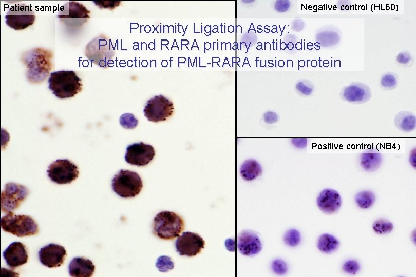 Patient sample Negative control (HL 60) Proximity Ligation Assay: PML and RARA primary antibodies