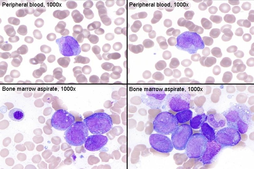 Peripheral blood, 1000 x Bone marrow aspirate, 1000 x 