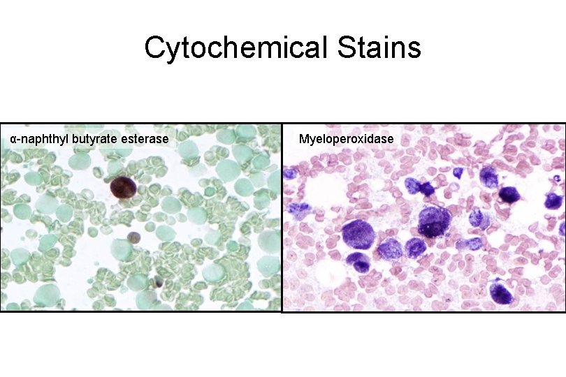 Cytochemical Stains α-naphthyl butyrate esterase Myeloperoxidase 