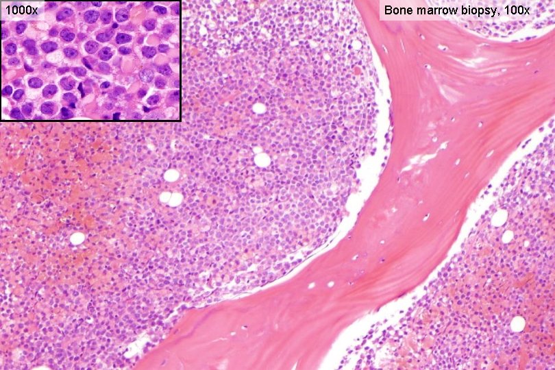 1000 x Bone marrow biopsy, 100 x 