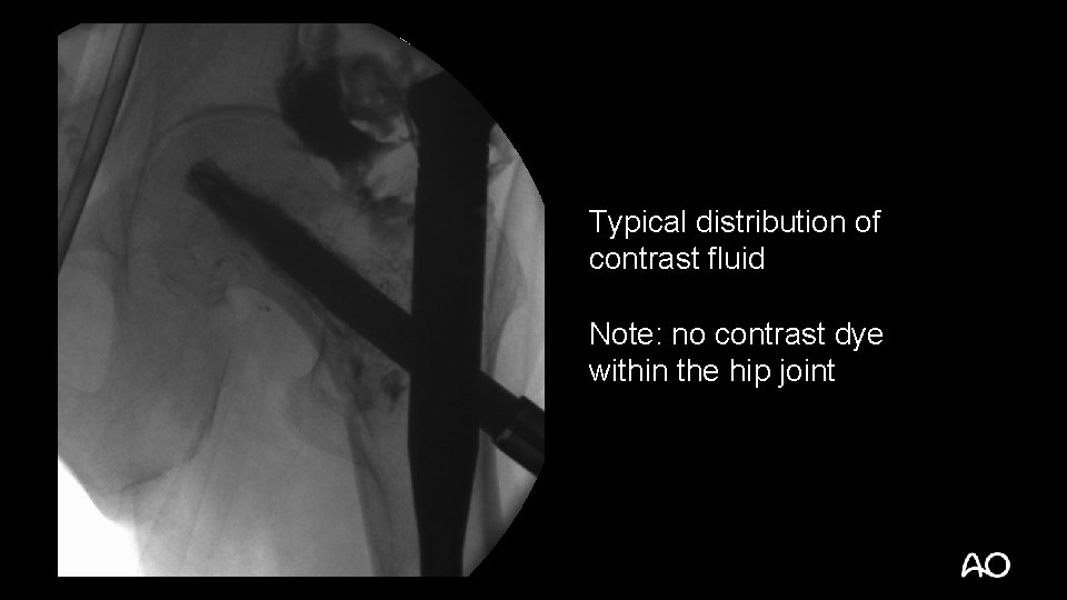 Typical distribution of contrast fluid Note: no contrast dye within the hip joint 