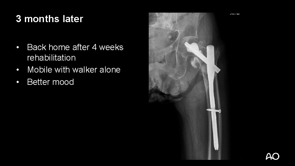 3 months later • Back home after 4 weeks rehabilitation • Mobile with walker