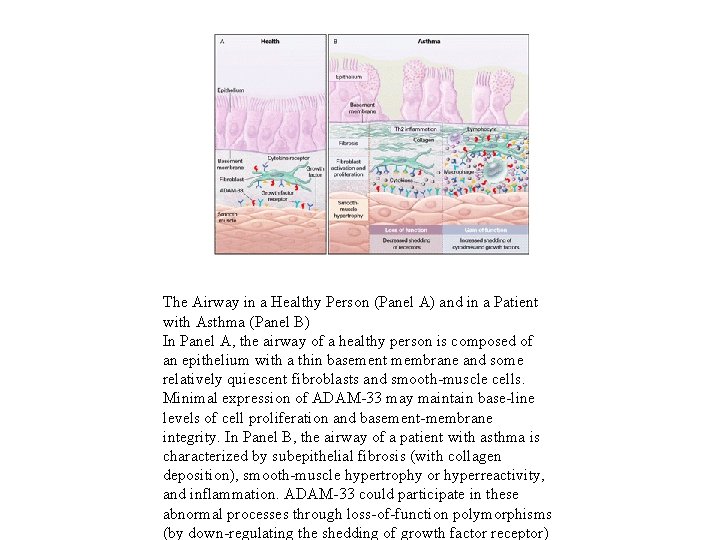 The Airway in a Healthy Person (Panel A) and in a Patient with Asthma