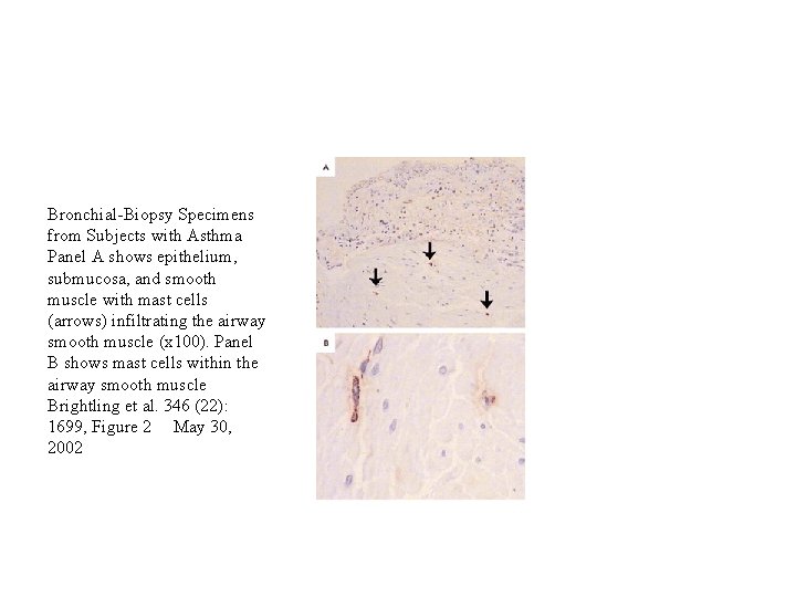 Bronchial-Biopsy Specimens from Subjects with Asthma Panel A shows epithelium, submucosa, and smooth muscle