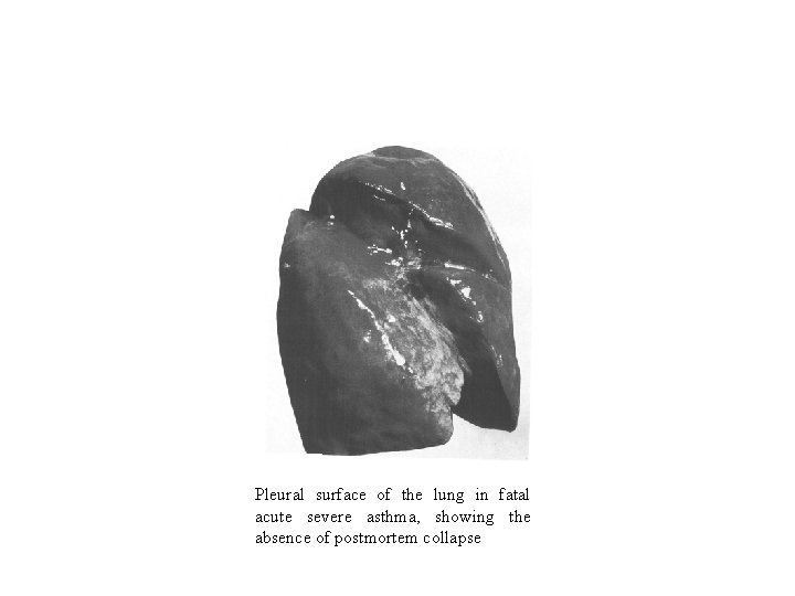 Pleural surface of the lung in fatal acute severe asthma, showing the absence of