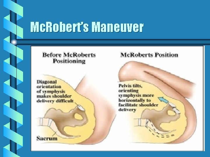 Mc. Robert’s Maneuver 