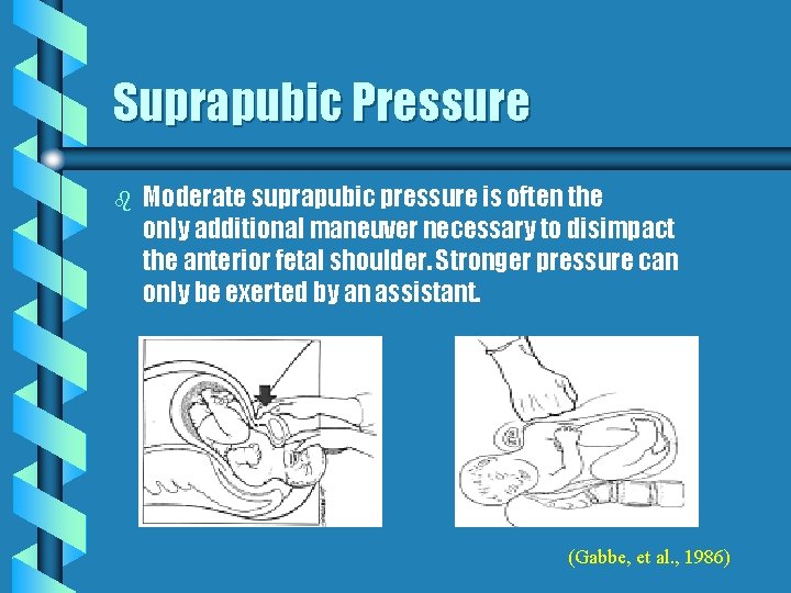 Suprapubic Pressure b Moderate suprapubic pressure is often the only additional maneuver necessary to