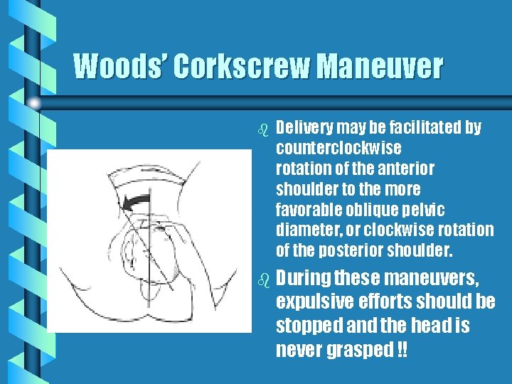 Woods’ Corkscrew Maneuver b Delivery may be facilitated by counterclockwise rotation of the anterior