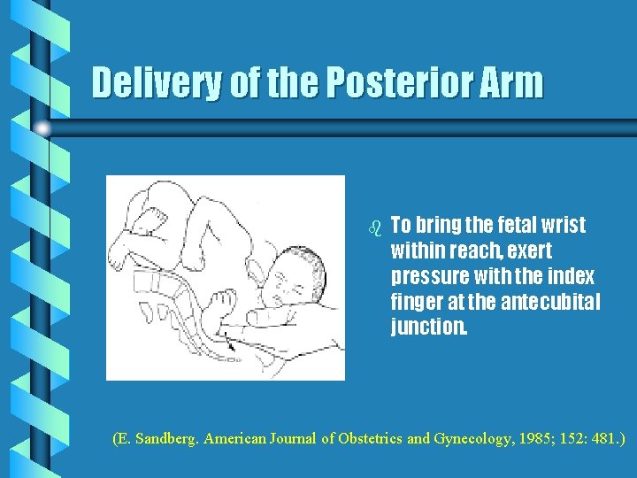 Delivery of the Posterior Arm b To bring the fetal wrist within reach, exert