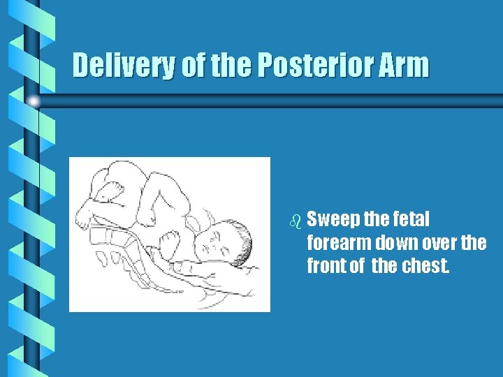 Delivery of the Posterior Arm b Sweep the fetal forearm down over the front
